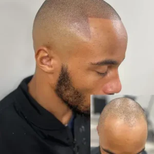 Hairline