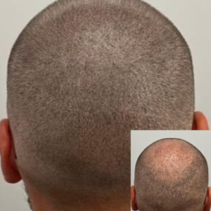 Bald Spot