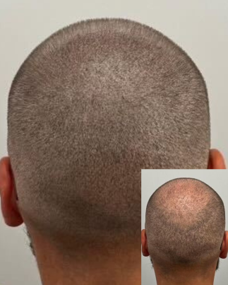 Bald Spot